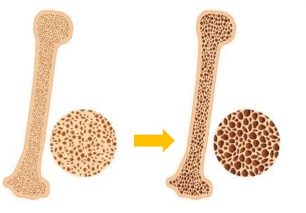 Kemik erimesi (Osteoporoz)